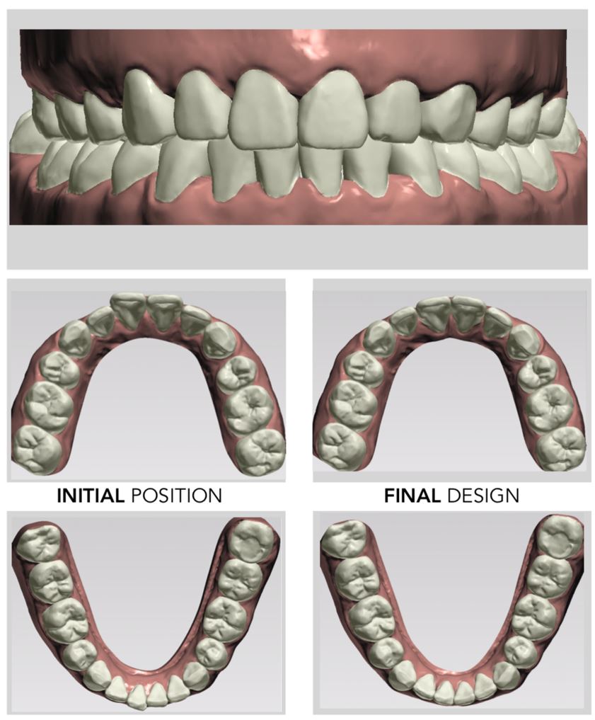 #7 การจำลองสภาพฟัน การจัดฟันใส ระบบ 3D